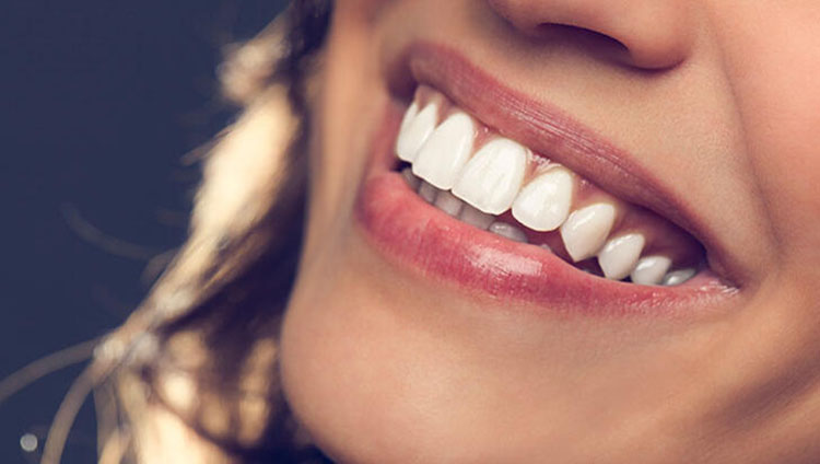 The most anticipated issues about laminate veneers